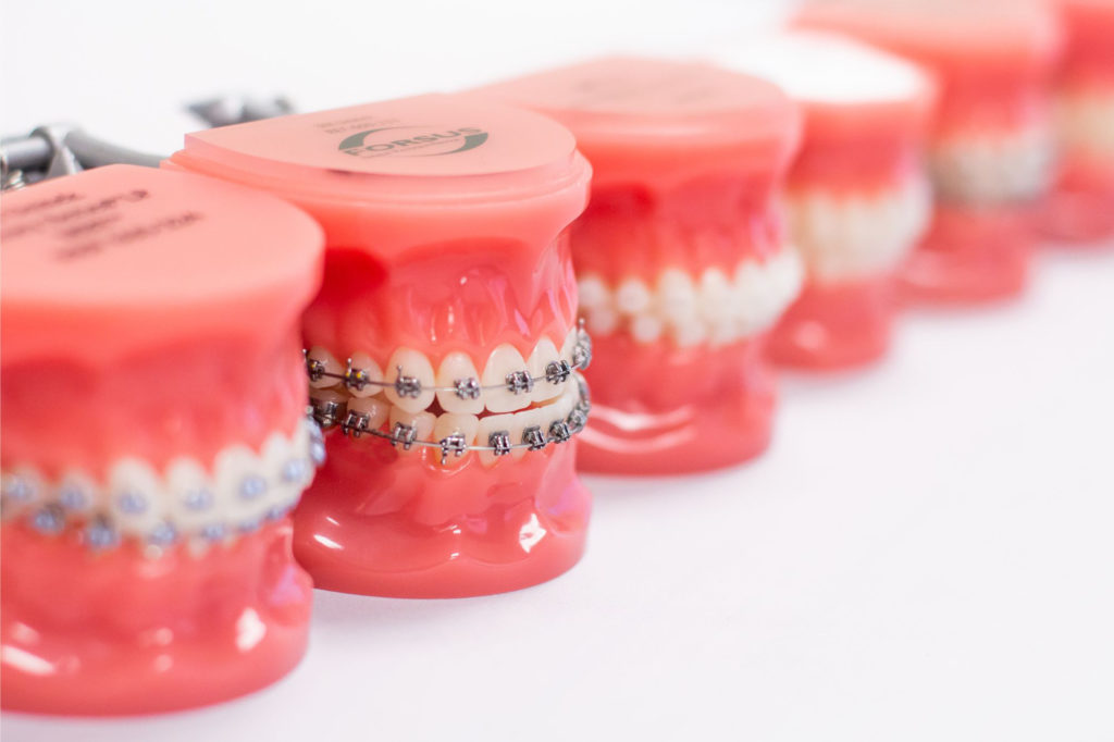 Models of teeth with braces demonstrating orthodontic treatment options available at Smiles to Love Orthodontics, highlighting Dublin braces for improved dental alignment and oral health.